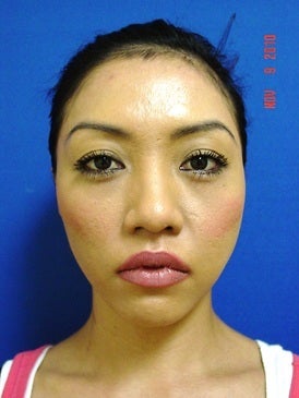Chin Augmentation/Rhinoplasty before 393380