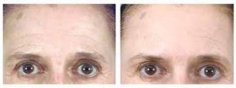 Botox and Browlift before 6321