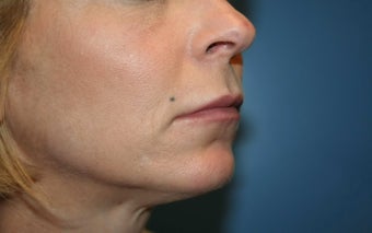 Lip Augmentation before 362762