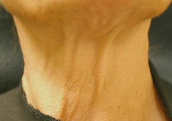 Botox Injections for Platisma Bands before 581434