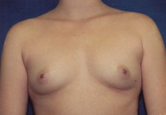 Breast Augmentation before 266922