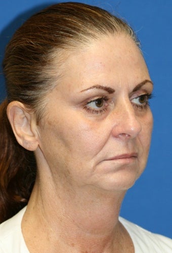 Facelift, Fat Transfer, Upper Bleph, Lower Eyelid Skin Pinch 424181
