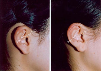 Earlobe Surgery before 243312