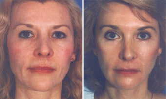 Facelift before 507837