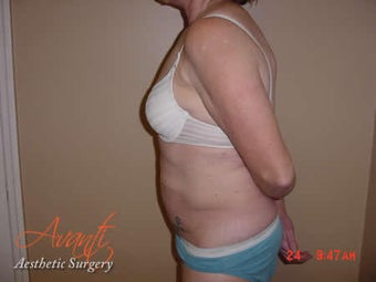 Body Jet after 379522