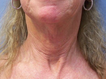 Neck lift before 591055