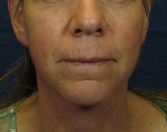 Laser Facelift after 249014