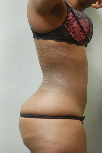 Upper and lower Abdomen & Flanks 346579