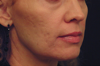 Yag Laser Skin Tightening 622085