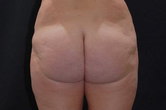 Buttock Augmentation through Fat Transfer after 423709