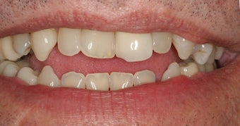 Porcelain Veneers Before and After (Smile Makeover) before 206793