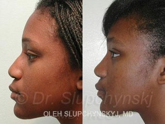 African American Rhinoplasty 374013