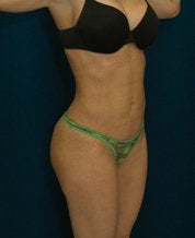 Brazilian Butt Lift on thin female after 567680