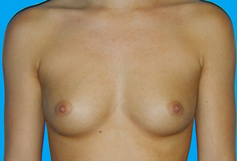 Breast Augmentation before 335916