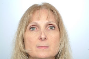 Revision Rhinoplasty before 358580
