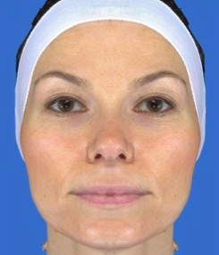 Chemical Peel after 469055