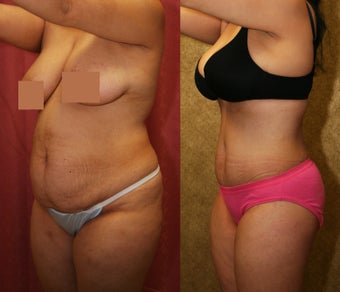 tummy tuck after 304704