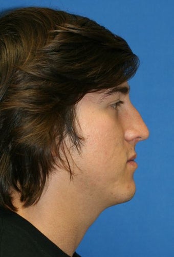 Rhinoplasty before 223240
