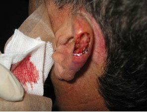 Skin Cancer Surgery on Ear before 561007