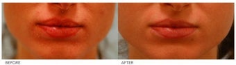 Lip Reduction/Lip Correction before 136730