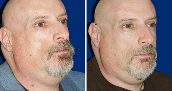 Sculptra after 496293