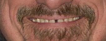 Porcelain Crowns before 374733