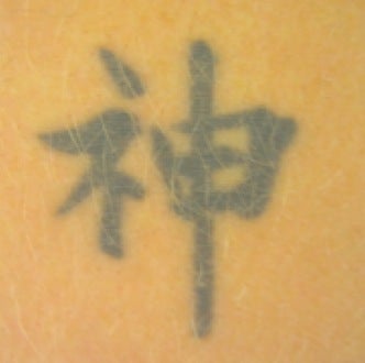 Laser tattoo removal before 374509