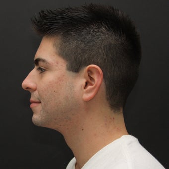 Laser Assisted Lipocontouring of the neck 540401