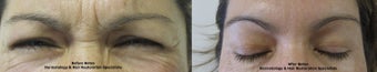 Botox before 387839