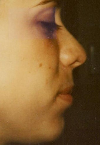 Rhinoplasty after 355872