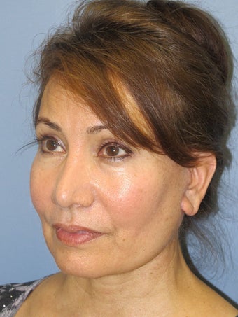 Chin Augmentation 635124