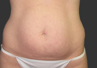 Exilis after 423764