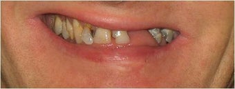 Full mouth Rehabilitation (Smile Makeover) before 390179