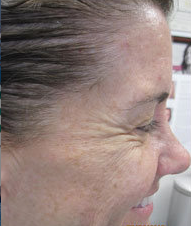 Botox 387834