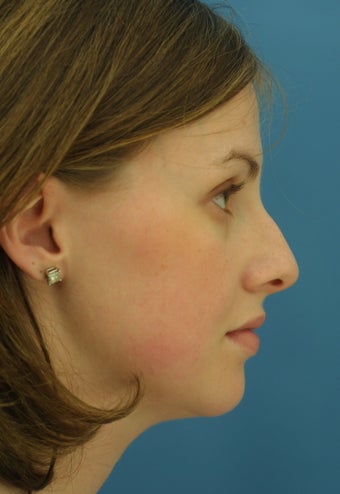 Rhinoplasty before 203539
