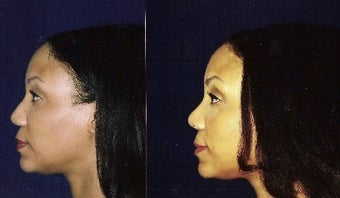 Rhinoplasty and Septoplasty before 241674