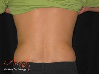 Vaser Lipo - Flanks before 376423