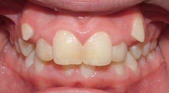 Teen Orthodontic Treatment (case #1RL) before 224710
