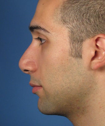 Revision Rhinoplasty 410801