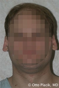 Otoplasty before 567309