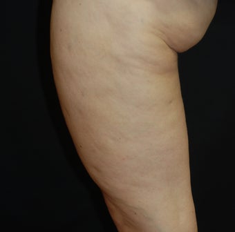 SmoothShapes Cellulite Treatment after 624764