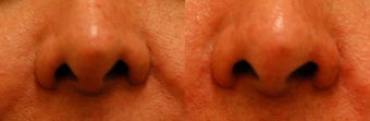 Revision/Corrective Rhinoplasty before 136573
