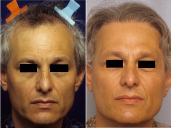 Hair replacement before 147596