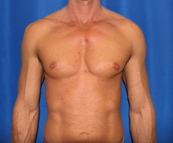 Pec Implants before 420119