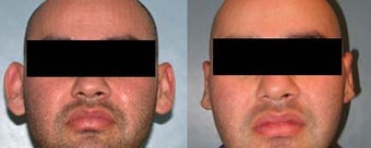 Otoplasty before 192159