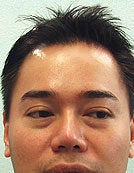 FUE – SFET Using Only Head Hair before 195671