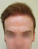 FUE – BHT by SFET Using Body and Head Hair to fix past Scalp Surgery after 195673