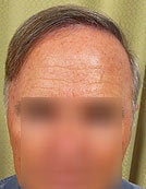 BHT – SFET Using Only Body Hair after 196027