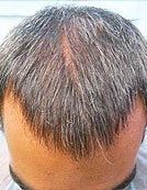 FUE – BHT by SFET Using Only Beard Hair after 196047