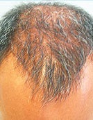 FUE – BHT by SFET Using Only Beard Hair before 196047